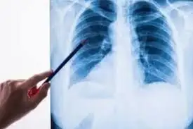 Қазақстанда пневмония әлі өршіп тұр