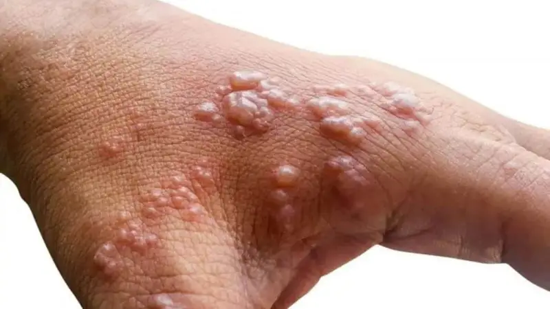 Әлемде маймыл шешегі өршіп барады