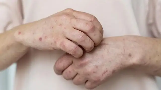 қызылша жұқтыру